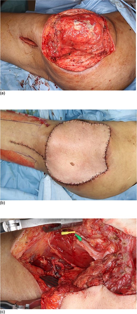 Intraoperative photographs of Case 3. A 73-year-old man underwent debridement for a left greater trochanteric ulcer and reconstruction by free latissimus dorsi myocutaneous flap. (a) The skin defect on the lateral thigh after the debridement of the ulcer. (b) Skin coverage after the reconstruction by free latissimus dorsi myocutaneous flap. (c) The thoracodorsal artery and vein, which feed the latissimus dorsi myocutaneous flap, were anastomosed to the third perforating branches of the deep femoral artery and vein.