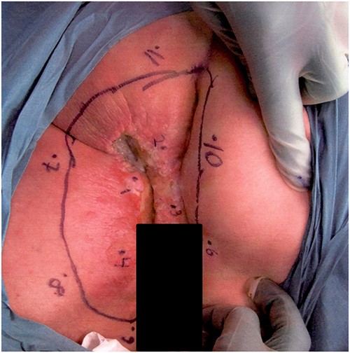 Photograph of the affected lesion in our first patient. Mapping biopsies confirms Paget’s disease in macroscopically normal tissue.