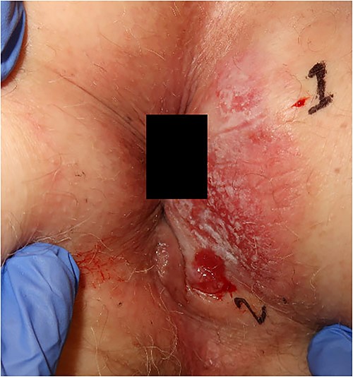 Photograph of the lesion in our second patient. Biopsies confirming Paget’s disease in biopsy marked 1 and Paget with underlying anal gland carcinoma in biopsy marked 2.