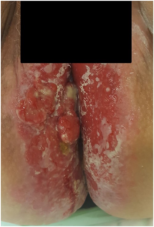 Photograph of the area with severe perianal dermatitis in our third patient. Biopsies show primary EMPD with invasion.