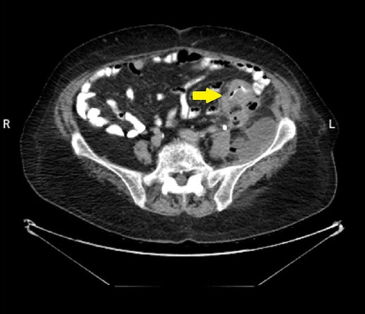 Abdominal CT scan with contrast showed the neoplasm and the presence of fluid collection (done at the time of the diagnosis of CC).