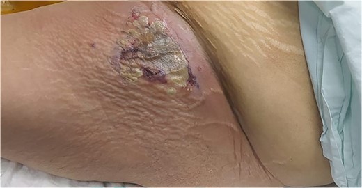 A large, tender erythematous swelling on the proximal anterolateral aspect of the left thigh. The swelling was fluctuant, with a black necrotic center.