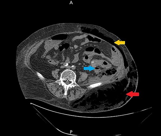 A non-contrast abdomen and pelvis CT scan, which shows a large amount of subcutaneous emphysema within the left flank soft tissues (lower arrow) that wrapped anteriorly along the left lower lateral abdominal wall into the anterior subcutaneous soft tissues of the left lower quadrant (upper arrow). There was also a small tract of air extending from the left retro peritoneum posterior to the left kidney and extending along the left iliopsoas muscle inferiorly (middle arrow).