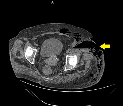 A non-contrast abdomen and pelvis CT scan, which shows a skin defect with underlying abscess collection and air–fluid level, with significant subcutaneous air collection.