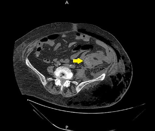 A non-contrast abdomen and pelvis CT scan, which shows a soft tissue mass lesion at the distal descending colon.
