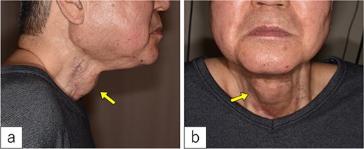 On admission. A 3-cm-sized cervical subcutaneous tumor was confirmed (arrow).