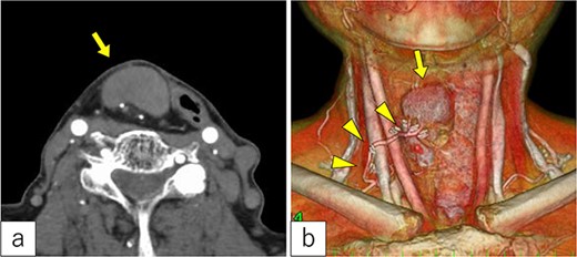 Radiological findings. (a) Computed tomography revealed a tumor under the cervical flap (arrow). (b) The tumor involved the vascular pedicle of the jejunal flap (arrowhead).