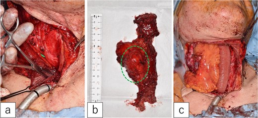 Second jejunal transfer. (a) There were no lesions in the lumen of the first jejunum. (b) The tumor was confined to the mesentery (dotted circle). (c) The first jejunum was replaced with the second jejunum.