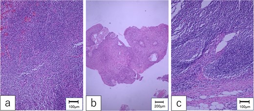 Pathological findings. (a) The specimen of hypopharyngeal cancer showed that dysmorphic cells with well-defined nucleoli were proliferating without polarity, diagnosed as moderately differentiated SCC. (b) The specimen of oropharyngeal cancer was compatible with well-differentiated SCC, which formed cancer pearls and papillary structures. (c) The mesenteric tumor of the first jejunum confirmed poorly differentiated SCC, which consisted of dysplastic cells with rounded nuclei and distinct nucleoli.