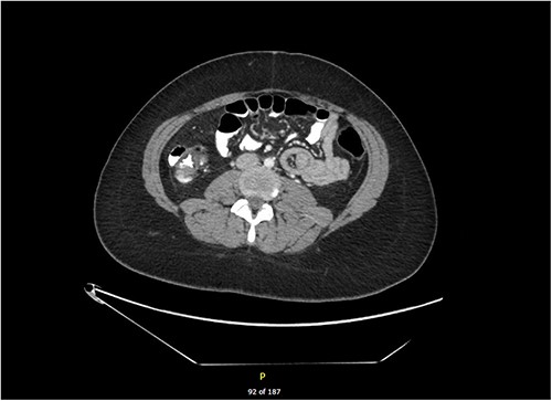 CT scan showing 8 cm jejunal intussusception.