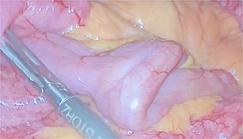 Jejunal intussusception.