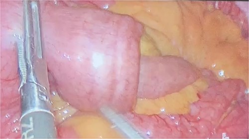 Jejunal intussusception.