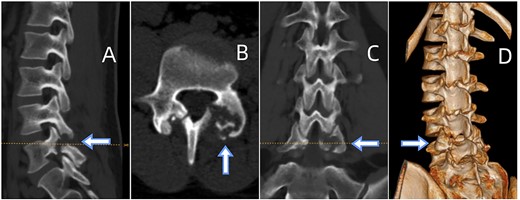 (A) Sagittal CT displaying lumbar spondylolysis at L5. (B) Axial CT revealing articular subchondral erosions and soft tissue masses at the left facet joint L5-S1. (C) Coronal CT and (D) 3D image demonstrating articular erosions and punched-out lesions of L5-S1, along with spondylolysis at L5.