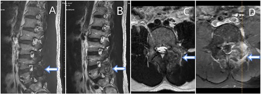 Depicts an MRI of the lumbar spine. (A) Sagittal sections of the T1-weighted. (B) A section of T2-weighted. (C) Axial section of the T2-weighted. (D) Contrast-enhanced T1-weighted. The presented images reveal an ovoid extra-dural mass measuring1.8◊1.1 cm at the subarticular area of the left L5-S1. This mass exhibits low signal intensity on T1-weighted (A) and hyperintense signal intensity on T2-weighted (B). Axial T2-weighted fat-suppressed with contrast enhancement is depicted at the L5-S1 level (C, D). The sequence illustrates a lesion that heterogeneously enhances and extends posteriorly from the left facet joint. Surrounding the L5-S1 left articular joint resection is a nodular chalky soft tissue mass.