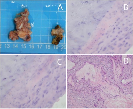 (A) Surgical pathology specimen. (B–D) Amorphous substance containing urate crystals surrounded by inflammatory cells and a multinucleated giant cell granuloma, magnified at H&E × 40.