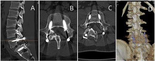 Postoperative CT of lumbar fusion surgery, depicted in (A) and (B). Two years postoperatively, DECT (displayed in (C) and (D)) reveals no urate deposition in the lumbar area.