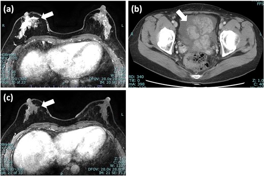 Imaging tests of right breast cancer and ovarian tumor. (a) MRI of the breast showed heterogeneous enhanced lesion below the nipple; (b) CT scan of pelvis revealed an ovarian tumor with increased ascites; (c) MRI after 5 months showed significant reduction in the size of tumor and diminished enhancement. MRI: magnetic resonance imaging; CT: computed tomography.