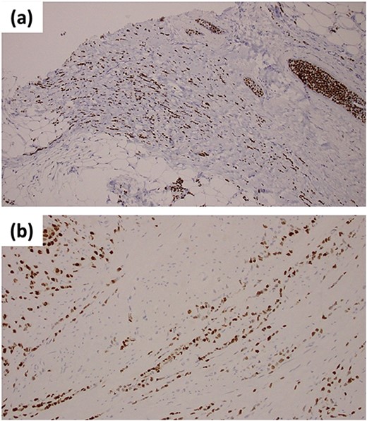 Immunohistochemical staining of ER (a) the primary breast lesion; (b) biopsy samples from the anterior wall of gastric antrum.