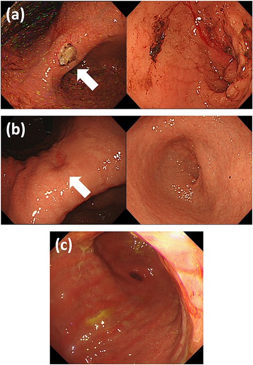 Upper GI endoscopy findings (a) at the first visit: ulcer at the gastric angle without pyloric stenosis; (b) when the symptoms recurred: healed gastric ulcer and diffusely thickened stenotic pyloric ring; and (c) after the bypass surgery: diffuse infiltration of tumor at the antrum. GI: gastrointestinal.