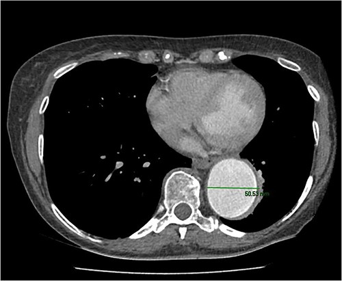 CT scan showing diameter of descending aorta measuring 50 mm.