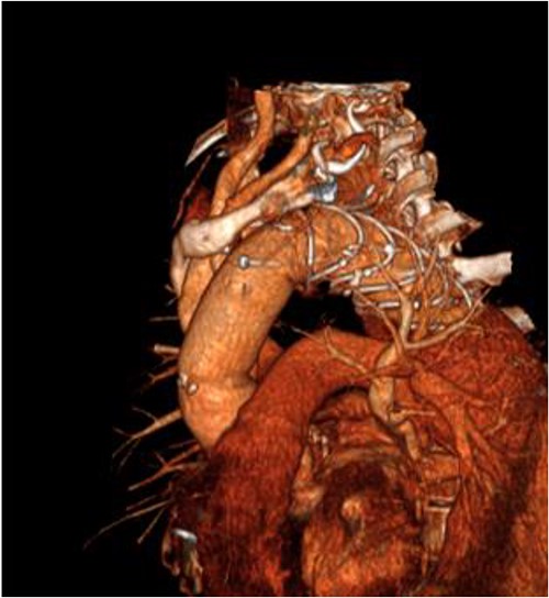 3D reconstructed CT aorta image showing successful FET implantation at zone 0.