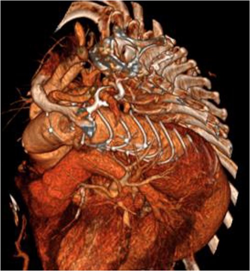 3D reconstructed CT aorta image showing successful FET implantation at zone 0.
