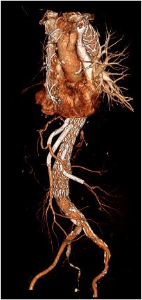3D reconstructed CT thoracic aorta image showing successful FET implantation and TEVAR.