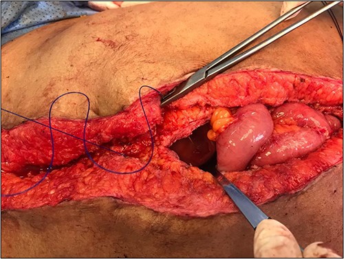 HIPEC- midline incision closure aided by spoon.