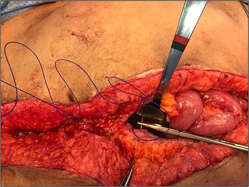 HIPEC- midline incision closure aided by spoon.