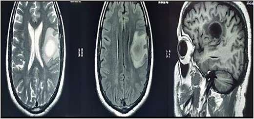 MRI brain with contrast—a heterogeneous irregular rim of an enhancing lesion with a size of 3.6 × 3.4 × 2.4 cm appearing in the left frontal subcortical region, with mild perilesional edema extending into the corona radiata and external capsule.