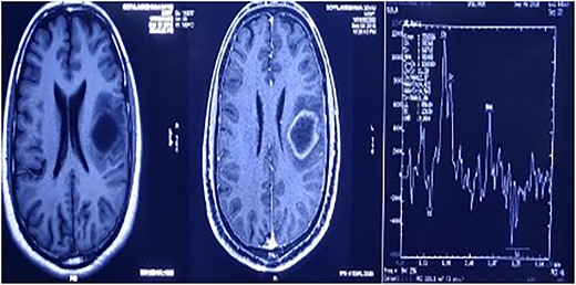 MRS showed an increased choline, reduced NAA, and prominent lipid/lactate peaks; (Ch/NAA-4.0) (Ch/Cr-1.7).