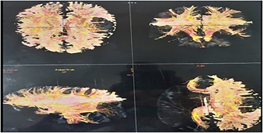 Tractography showing destruction of the left superior longitudinal fasciculus, superior occipito-frontal fasciculus, and partial destruction of the left cortical spinal tract.