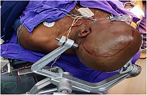 The patient was positioned in the supine position, with the head fixed with a three-pin holder.