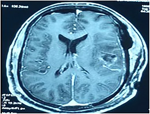 Contrast MRI depicting the tumor cavity and gross total resection.