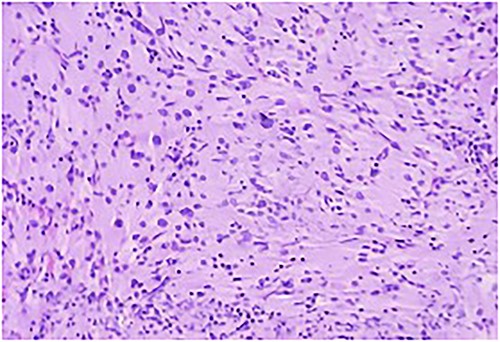 Section study shows a poorly defined mass composed of sheets of cells separated by thin collagenous bands; cells are round to polygonal with abundant eosinophilic cytoplasm with coarse granules; cell border is distinct at places with a syncytial pattern at some area; nuclei is large and vesicular.