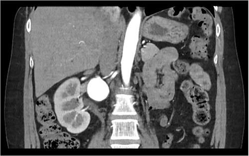 Coronal CT abdomen/pelvis of RAA.