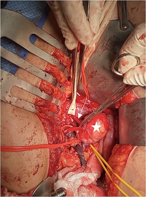 Intraoperative picture of RAA. Penrose is around the inferior vena cava, arrow shows the renal artery, star is on the RAA, and yellow vessel loop is around the renal vein.
