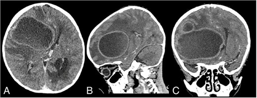 Admission contrast head CT scan showing a large hypodense lesion with ring-enhancement on the right frontotemporoparietal lobe; (A) axial view; (B) sagittal view; (C) coronal view.