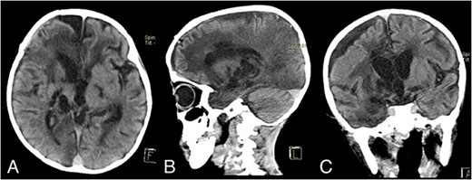 Discharge noncontrast head CT scan showing that the abscess has been completely removed; (A) axial view; (B) sagittal view; (C) coronal view.