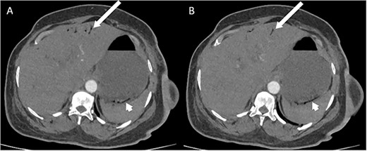 CT pulmonary angiogram images demonstrating moderate amount of branching linear gas in the liver (long arrows), most pronounced in (A) at the level of T11/12; gas within the wall of the gastric fundus (short arrows) can be appreciated more in (B) at the level of T11.