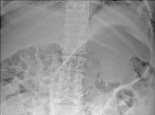 Plain film radiograph of the abdomen demonstrating a distended and gas-filled stomach.