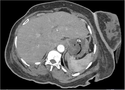 CT abdomen and pelvis image demonstrating interval resolution of portal venous gas, at the level of T11/12.