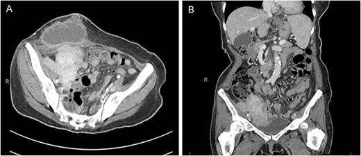 Computed tomography of the abdomen and pelvis in the axial (A) and coronal (B) planes demonstrating a 7.8 × 4.3 cm mass along the right pelvic sidewall and necrotic mass in the anterior abdominal wall with a cutaneous fistula.