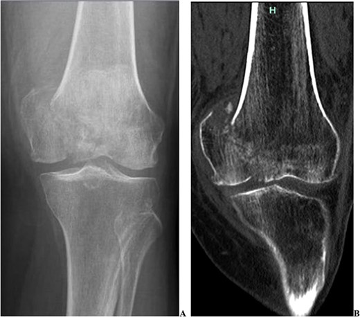 Two pre-operative injury images demonstrating the acute medial condyle distal femur fracture of the left knee. In addition to the acute fracture, one can appreciate the pre-existing osteoarthritis. (A) Radiograph demonstrating a large displaced medial condyle fracture. (B) CT scan re-demonstrating the acute medial condyle fractures.