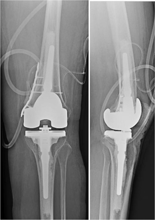 Two post-operative radiographs of the left knee demonstrating the constrained condylar knee arthroplasty, along with the open reduction internal fixation of the medial condyle using a distal fibula locking plate in buttress mode.