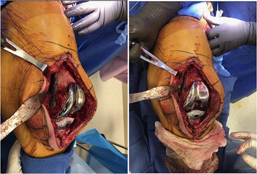 Two intra-operative images demonstrating the medial para-patellar approach used the open reduction internal fixation of the medial condyle with a distal fibula locking plate, and the constrained condylar knee arthroplasty. These images demonstrate the final construct immediately prior to closure.