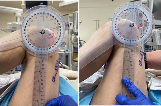 Two intra-operative images demonstrating the pre-manipulation flexion of 70°, and the post-manipulation flexion of 115°.
