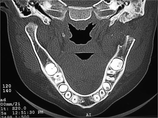 Post-operative coronal section CT image.
