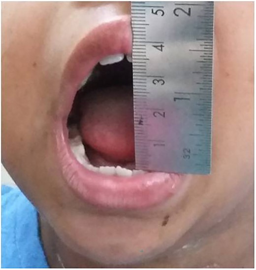 Follow-up after 6 months.