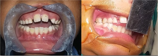 Pre-operative MIO (5 mm).